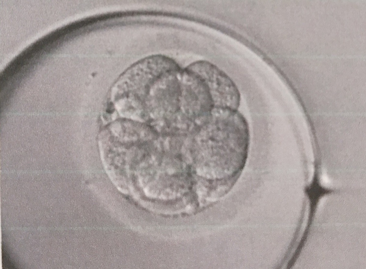 3度目の採卵と体外受精