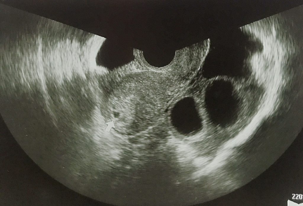 胎嚢確認　5w3d