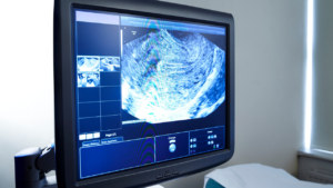 6W4Dで心拍確認できず→7W1Dで心拍確認はできたものの、絨毛膜下血腫に